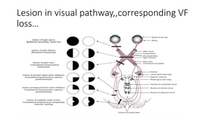 Lesion in visual pathway,,corresponding VF
loss…
 