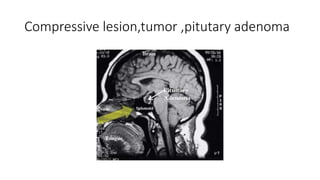 Compressive lesion,tumor ,pitutary adenoma
 