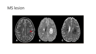 MS lesion
 
