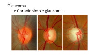 Glaucoma
i,e Chronic simple glaucoma….
 