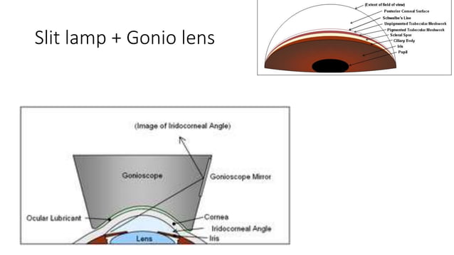 Gradual Visual loss.pptx