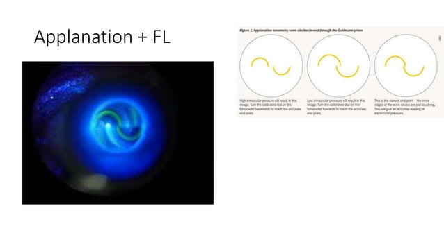 Gradual Visual loss.pptx