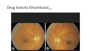 Drug toxicity Ethambutol,,,
 