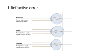 1-Refractive error
 