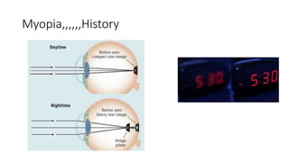Myopia,,,,,,History
 