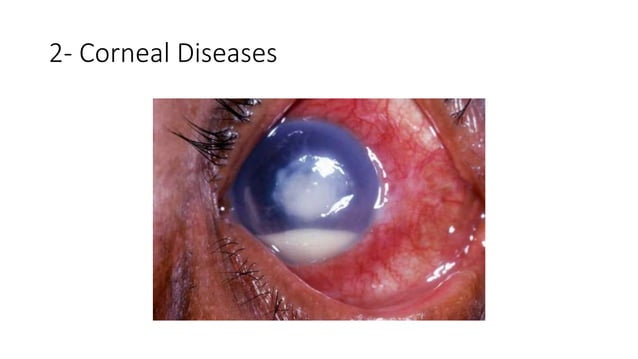 Gradual Visual loss.pptx