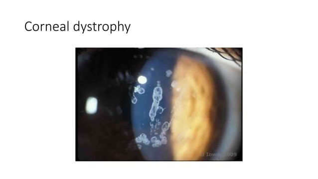 Gradual Visual loss.pptx