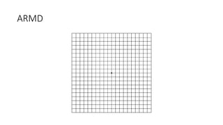 ARMD
 