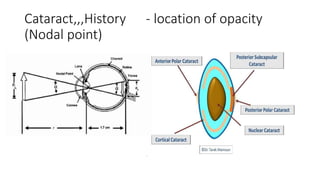 Cataract,,,History - location of opacity
(Nodal point)
 
