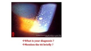 What is your diagnosis ?
Mention the ttt briefly ?
 