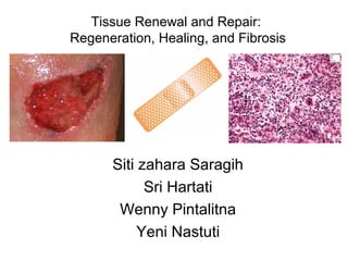 Tissue Renewal and Repair:
Regeneration, Healing, and Fibrosis
Siti zahara Saragih
Sri Hartati
Wenny Pintalitna
Yeni Nastuti
 