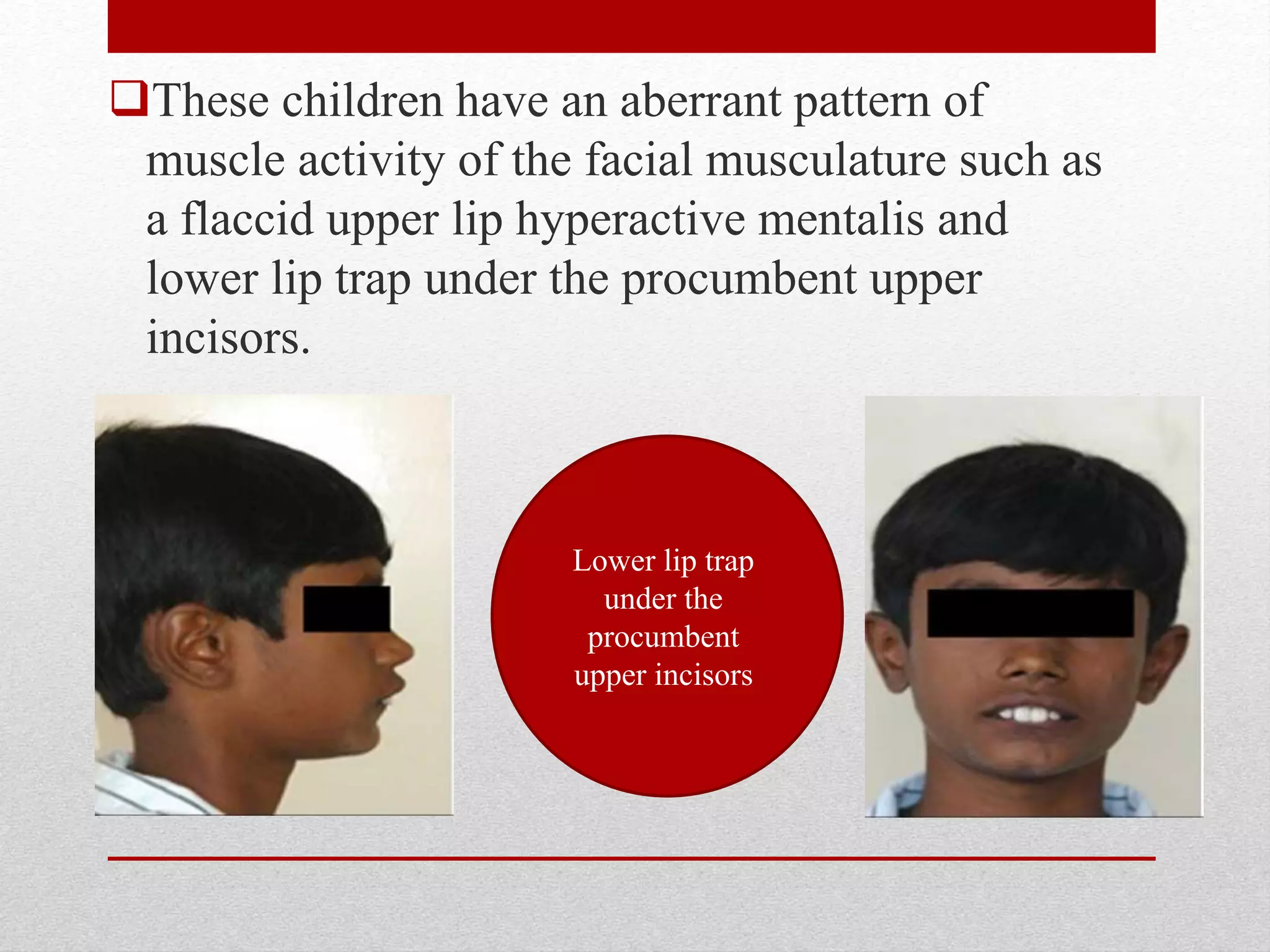 These children have an aberrant pattern of
muscle activity of the facial musculature such as
a flaccid upper lip hyperactive mentalis and
lower lip trap under the procumbent upper
incisors.
Lower lip trap
under the
procumbent
upper incisors
 