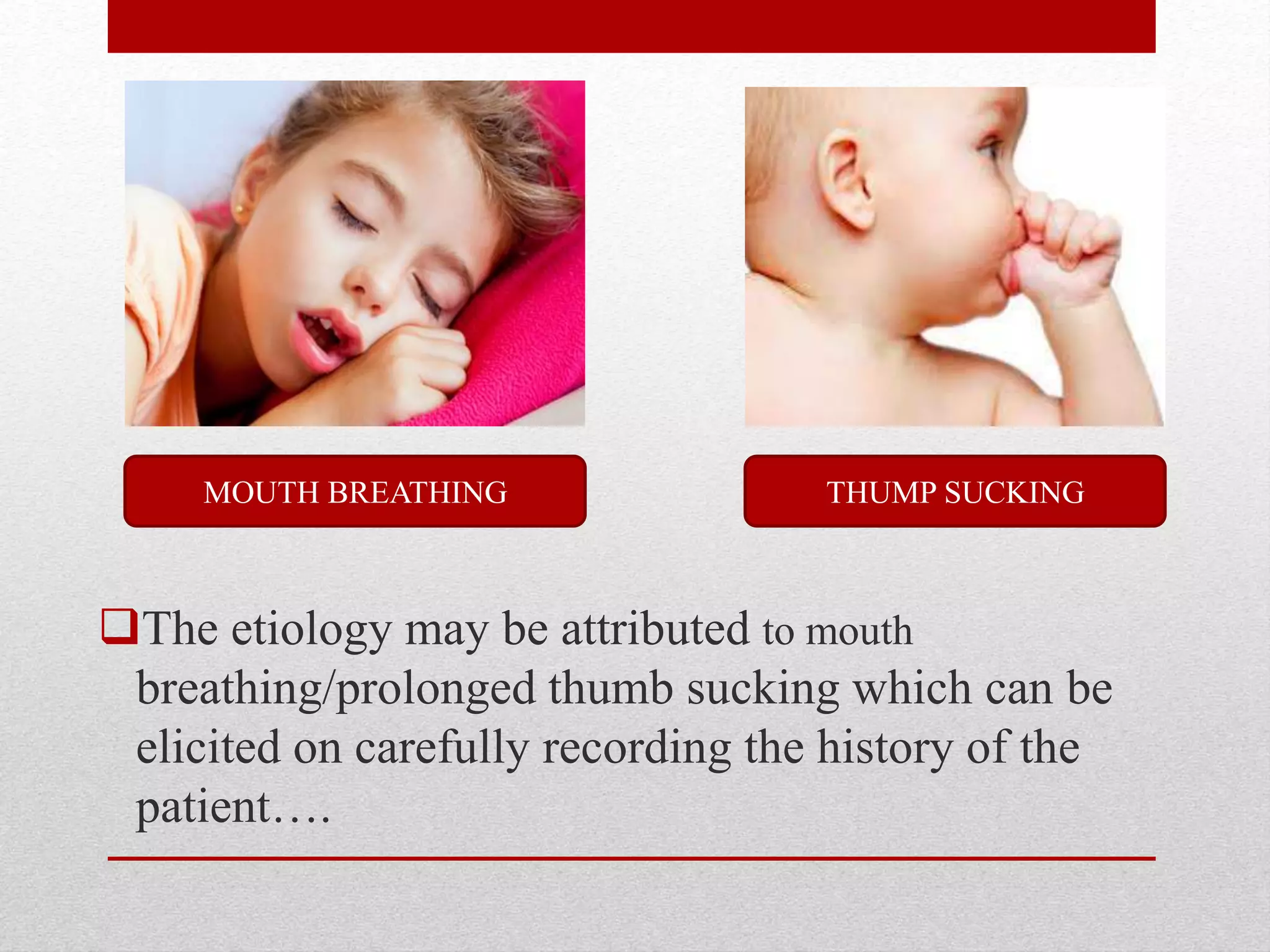 The etiology may be attributed to mouth
breathing/prolonged thumb sucking which can be
elicited on carefully recording the history of the
patient….
THUMP SUCKINGMOUTH BREATHING
 