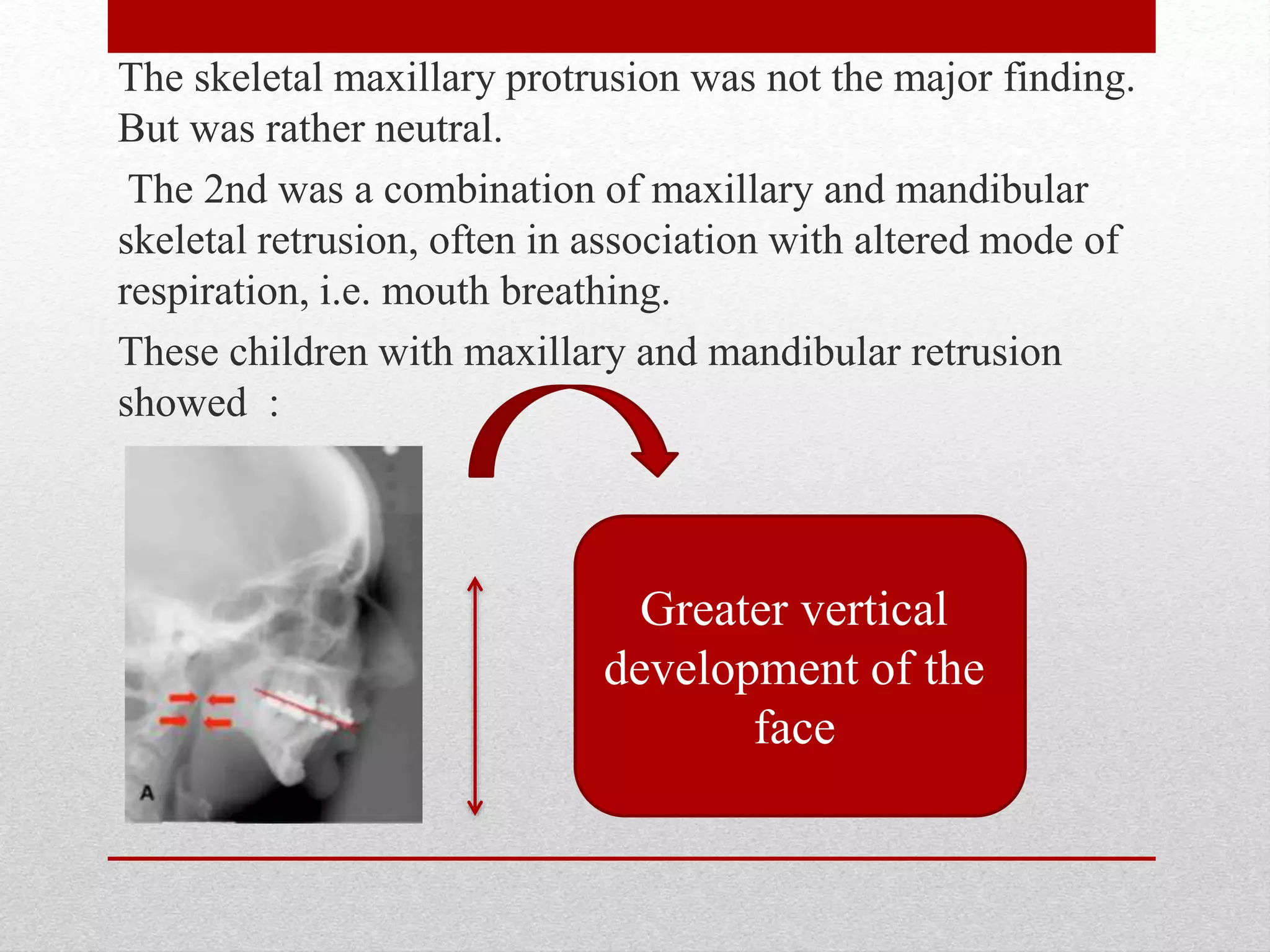 The skeletal maxillary protrusion was not the major finding.
But was rather neutral.
The 2nd was a combination of maxillary and mandibular
skeletal retrusion, often in association with altered mode of
respiration, i.e. mouth breathing.
These children with maxillary and mandibular retrusion
showed :
Greater vertical
development of the
face
 