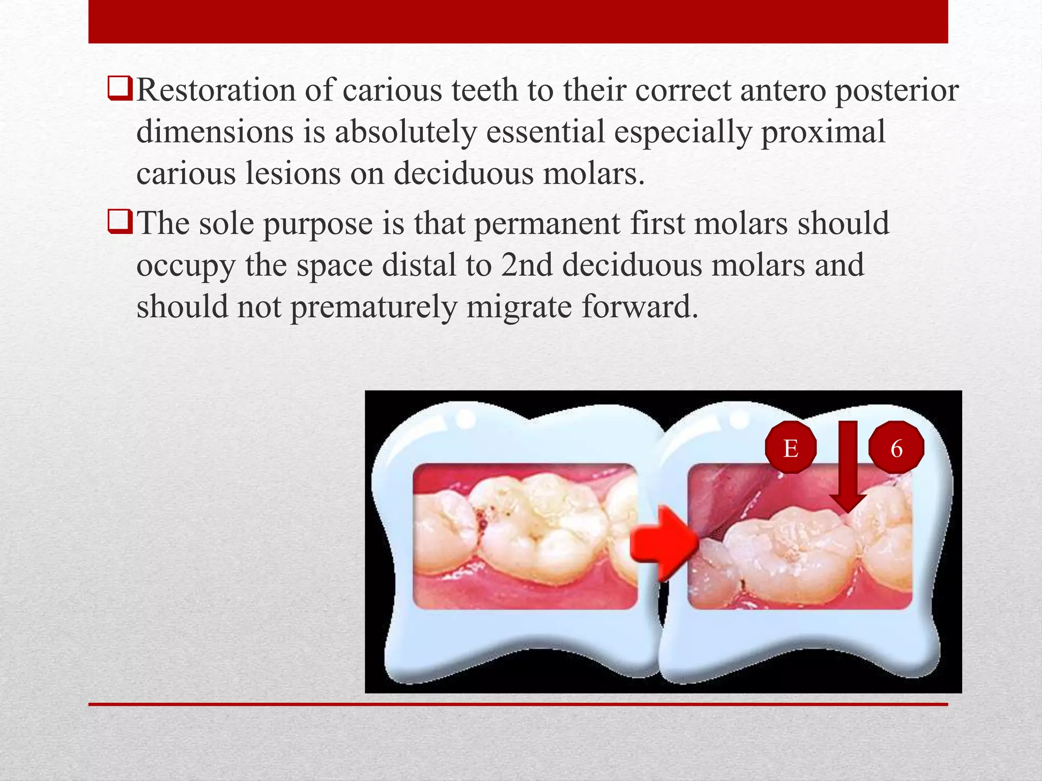 Restoration of carious teeth to their correct antero posterior
dimensions is absolutely essential especially proximal
carious lesions on deciduous molars.
The sole purpose is that permanent first molars should
occupy the space distal to 2nd deciduous molars and
should not prematurely migrate forward.
6E
 
