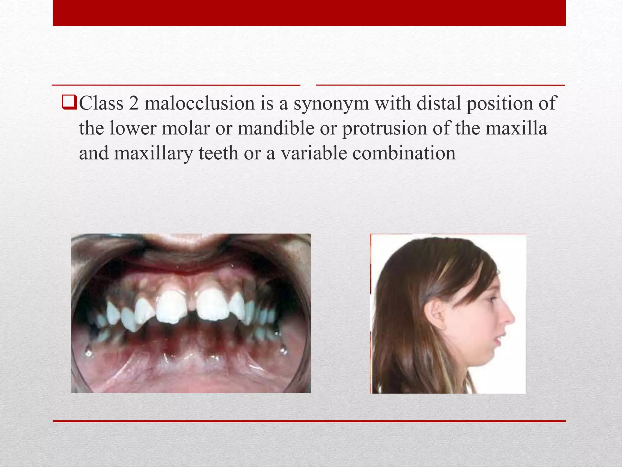 Class 2 malocclusion is a synonym with distal position of
the lower molar or mandible or protrusion of the maxilla
and maxillary teeth or a variable combination
 