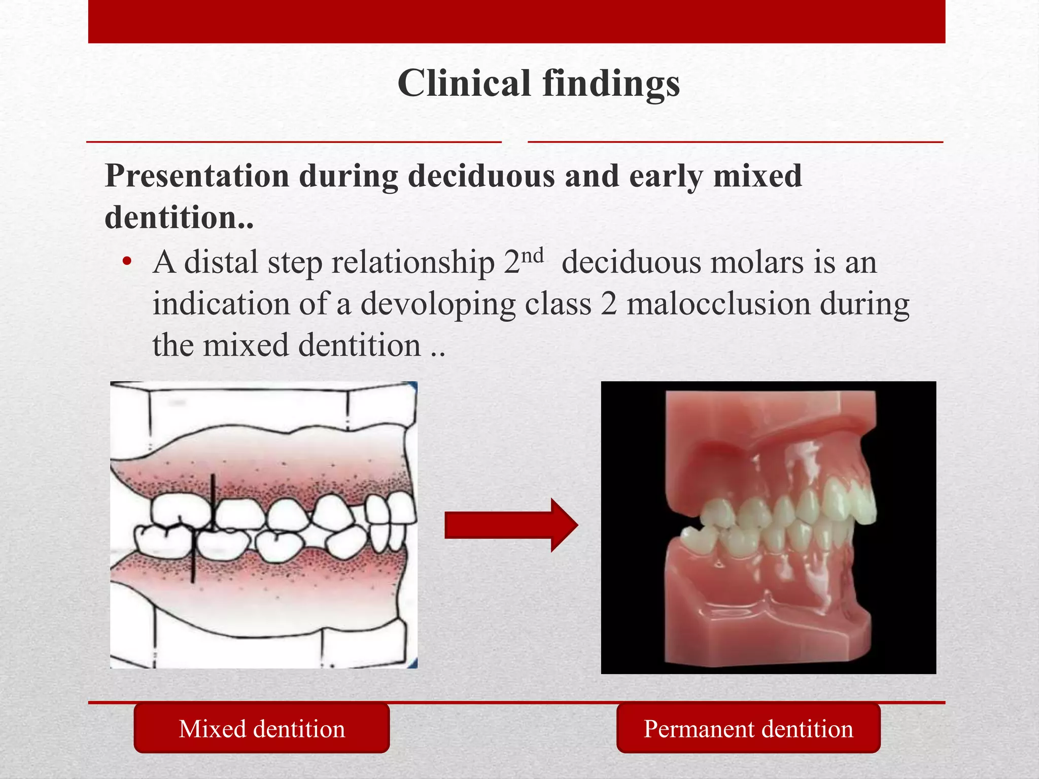 Clinical findings
• A distal step relationship 2nd deciduous molars is an
indication of a devoloping class 2 malocclusion during
the mixed dentition ..
Presentation during deciduous and early mixed
dentition..
Mixed dentition Permanent dentition
 