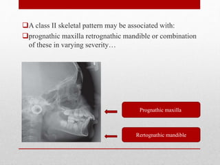 A class II skeletal pattern may be associated with:
prognathic maxilla retrognathic mandible or combination
of these in varying severity…
Prognathic maxilla
Rertognathic mandible
 