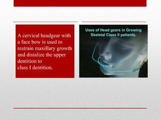 A cervical headgear with
a face bow is used to
restrain maxillary growth
and distalize the upper
dentition to
class I dentition.
 