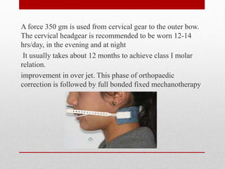 A force 350 gm is used from cervical gear to the outer bow.
The cervical headgear is recommended to be worn 12-14
hrs/day, in the evening and at night
It usually takes about 12 months to achieve class I molar
relation.
improvement in over jet. This phase of orthopaedic
correction is followed by full bonded fixed mechanotherapy
 