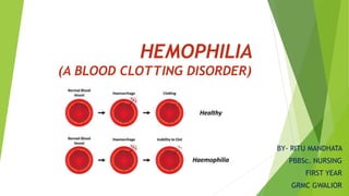 HEMOPHILIA
(A BLOOD CLOTTING DISORDER)
BY- RITU MANDHATA
PBBSc. NURSING
FIRST YEAR
GRMC GWALIOR
 