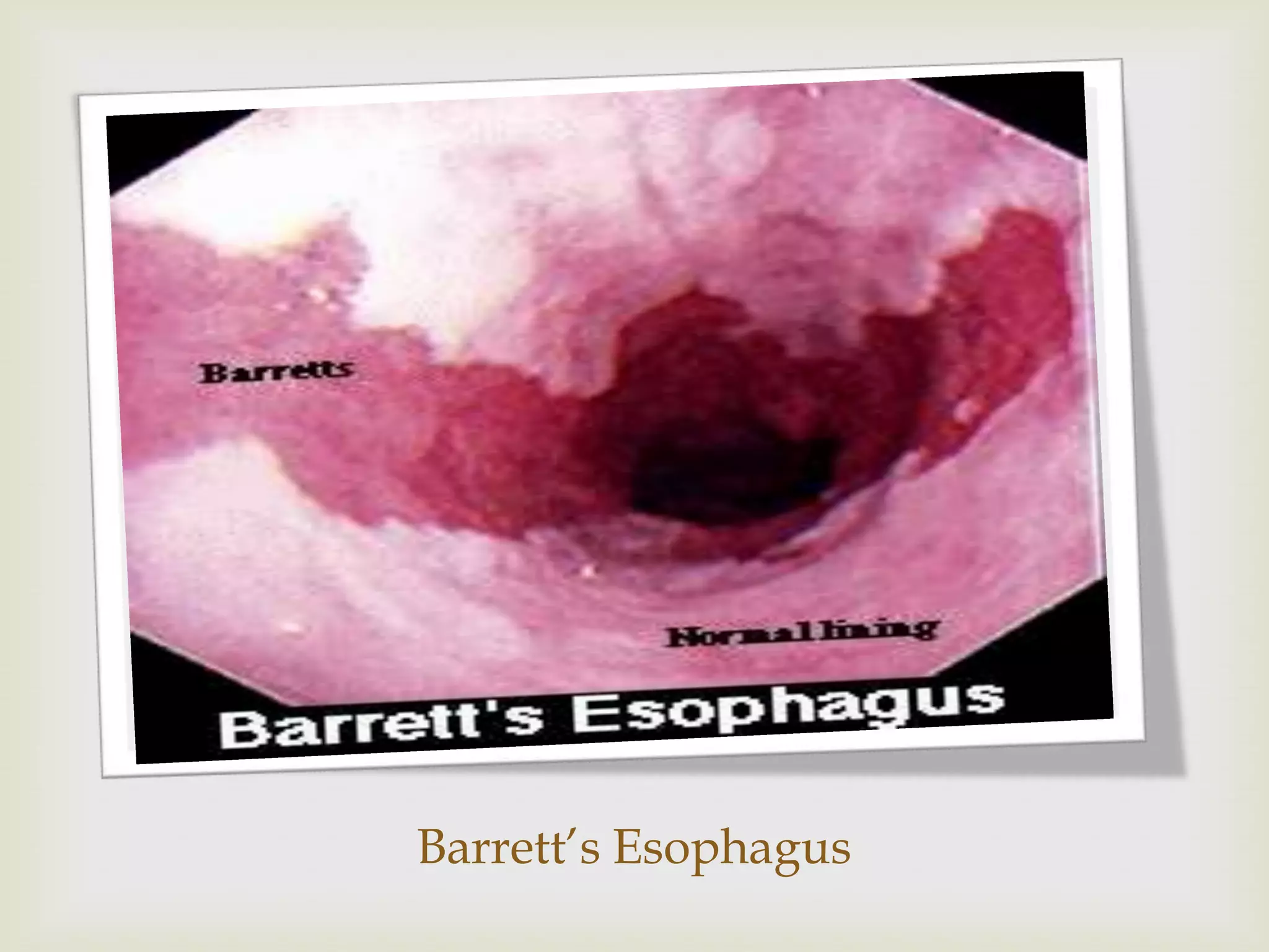 Barrett’s Esophagus
