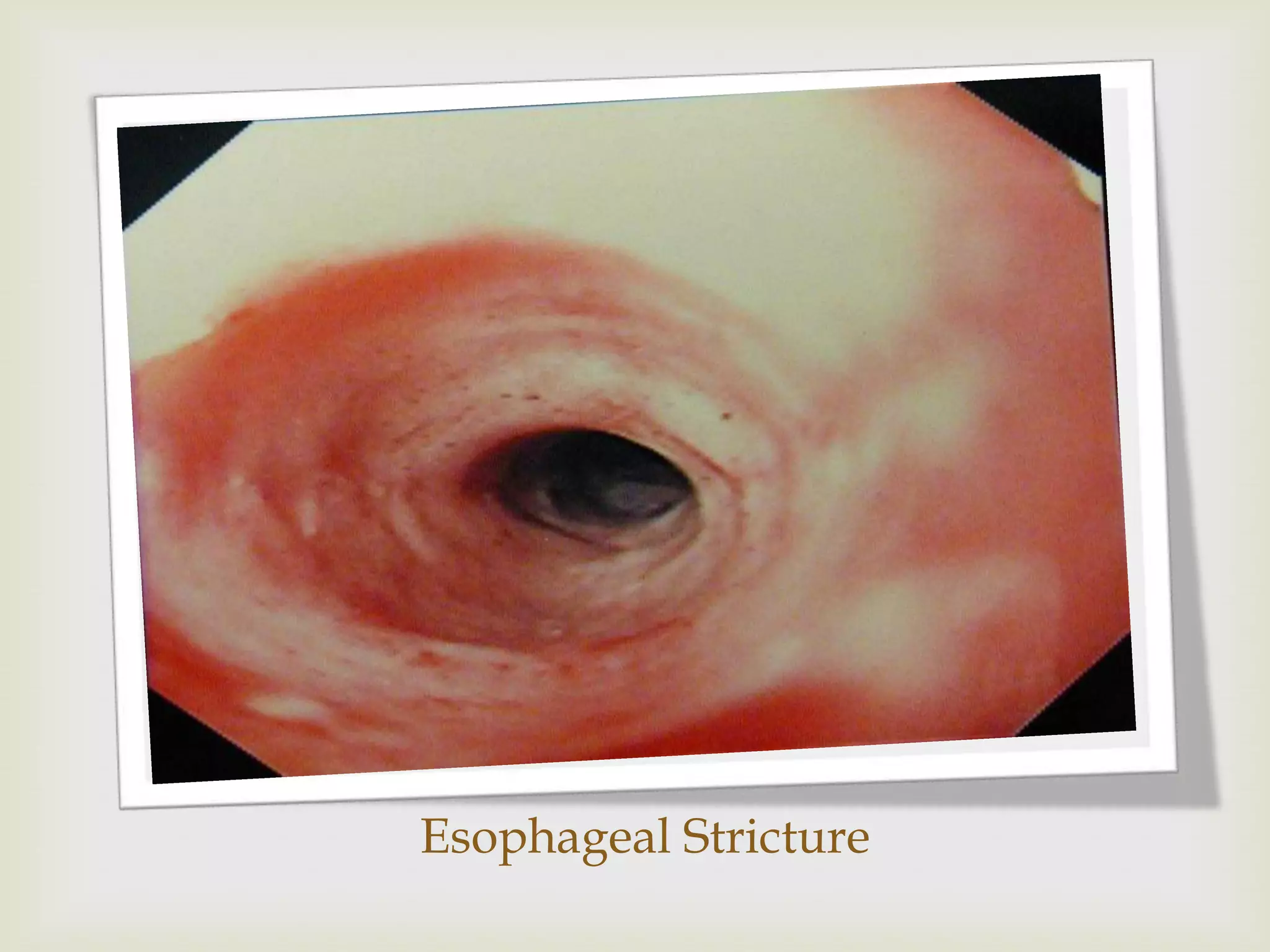 Esophageal Stricture