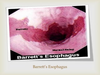 Barrett’s Esophagus