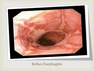 Reflux Esophagitis