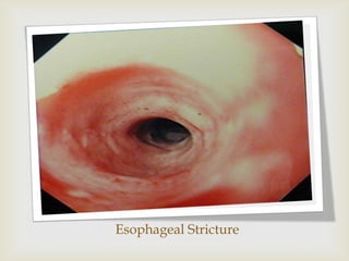 Esophageal Stricture