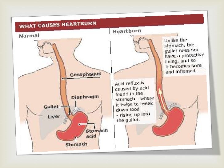 What are the symptoms of GERD?