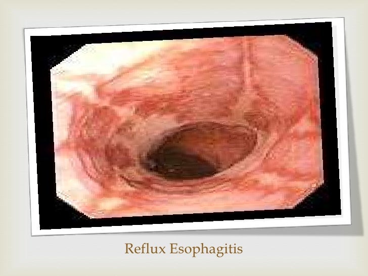 Presentation IBS & GERD