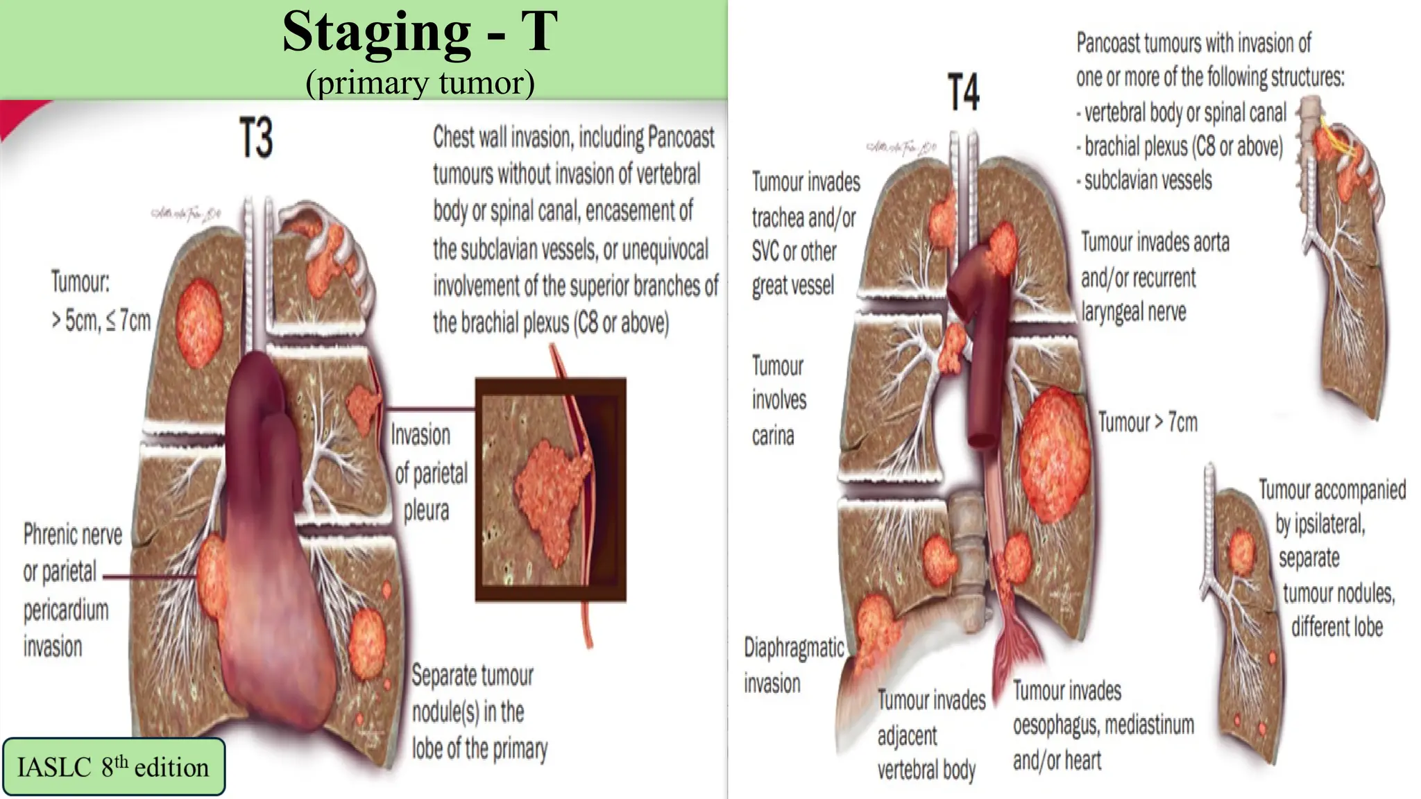 13
Staging - T
(primary tumor) T2
 