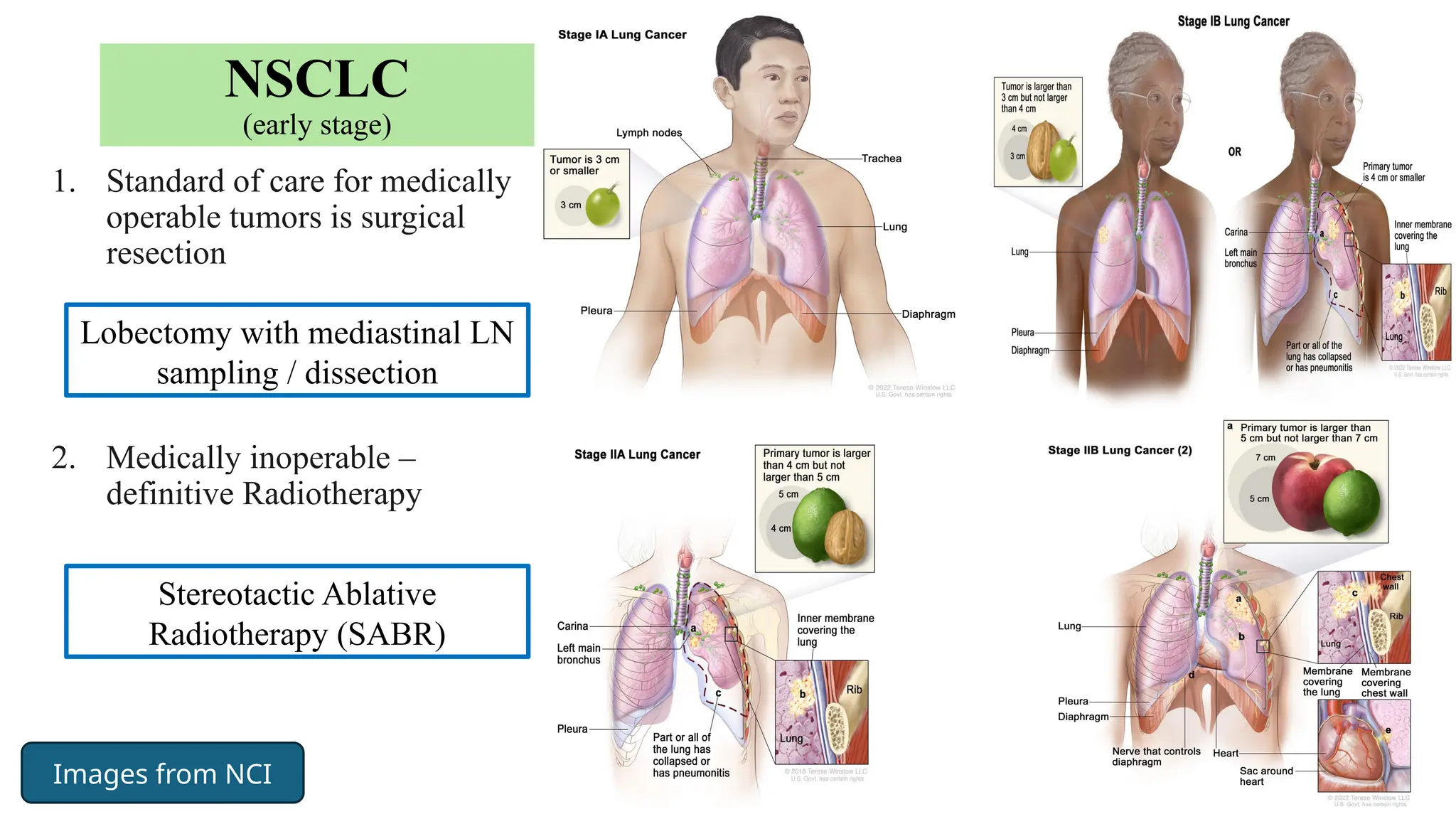 21
NSCLC
(early stage)
1. Standard of care for medically
operable tumors is surgical
resection
2. Medically inoperable –
definitive Radiotherapy
Lobectomy with mediastinal LN
sampling / dissection
Stereotactic Ablative
Radiotherapy (SABR)
Images from NCI
 