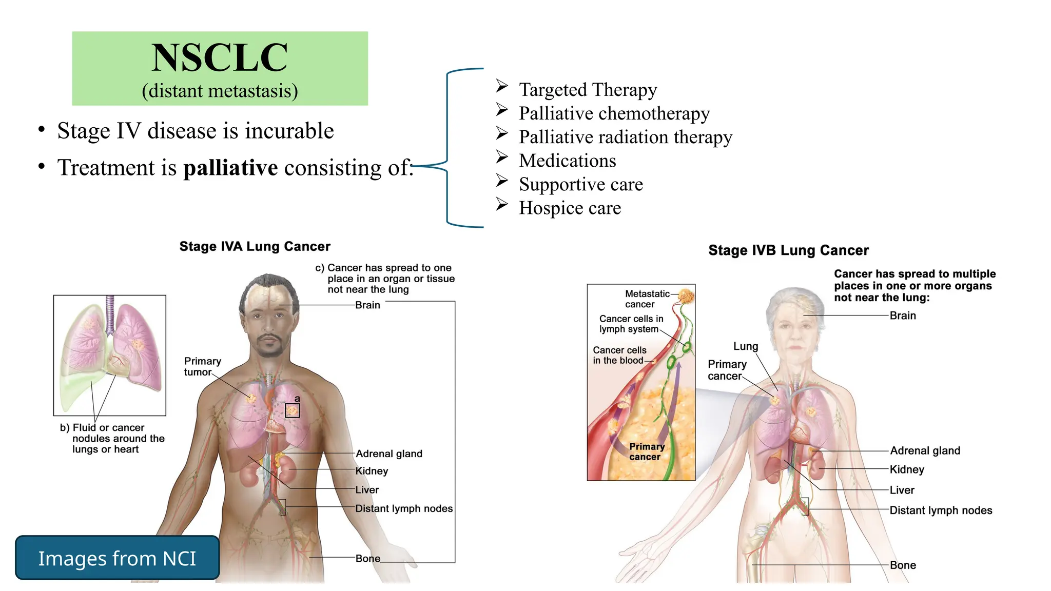 52
NSCLC
(distant metastasis)
• Stage IV disease is incurable
• Treatment is palliative consisting of:
 Targeted Therapy
 Palliative chemotherapy
 Palliative radiation therapy
 Medications
 Supportive care
 Hospice care
Images from NCI
 