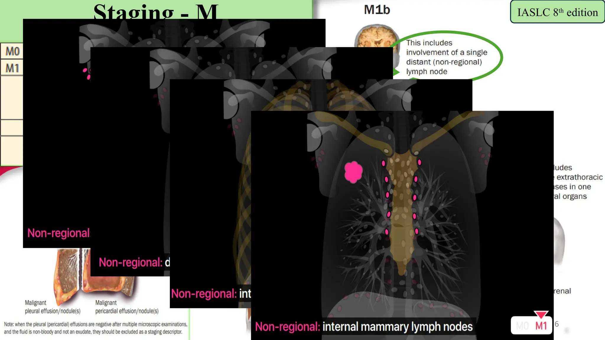 6
Staging - M
(distant metastasis)
IASLC 8th
edition
 