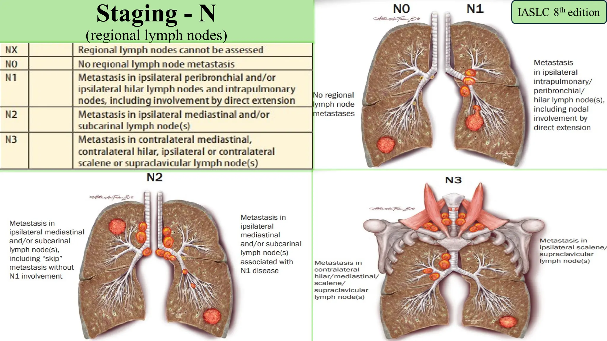 7
Staging - N
(regional lymph nodes)
 