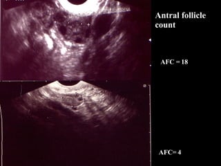 Antral follicle count AFC = 18 AFC= 4 