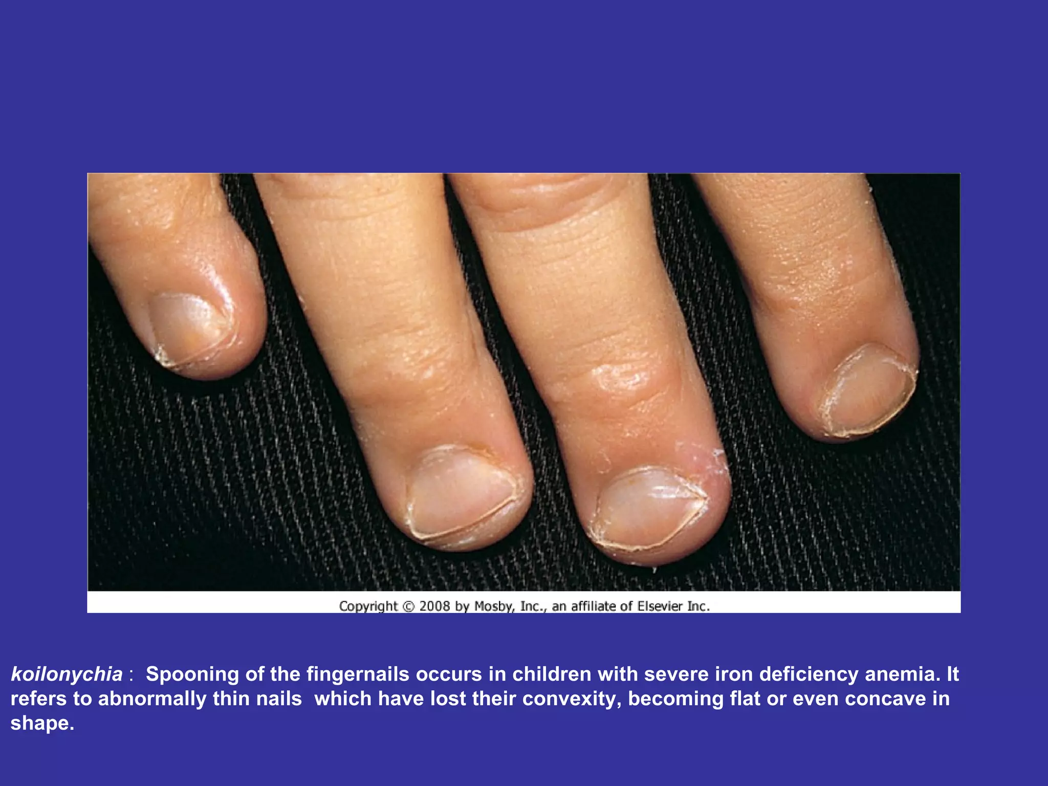 koilonychia  :   Spooning of the fingernails occurs in children with severe iron deficiency anemia. It refers to abnormally thin nails  which have lost their convexity, becoming flat or even concave in shape.  