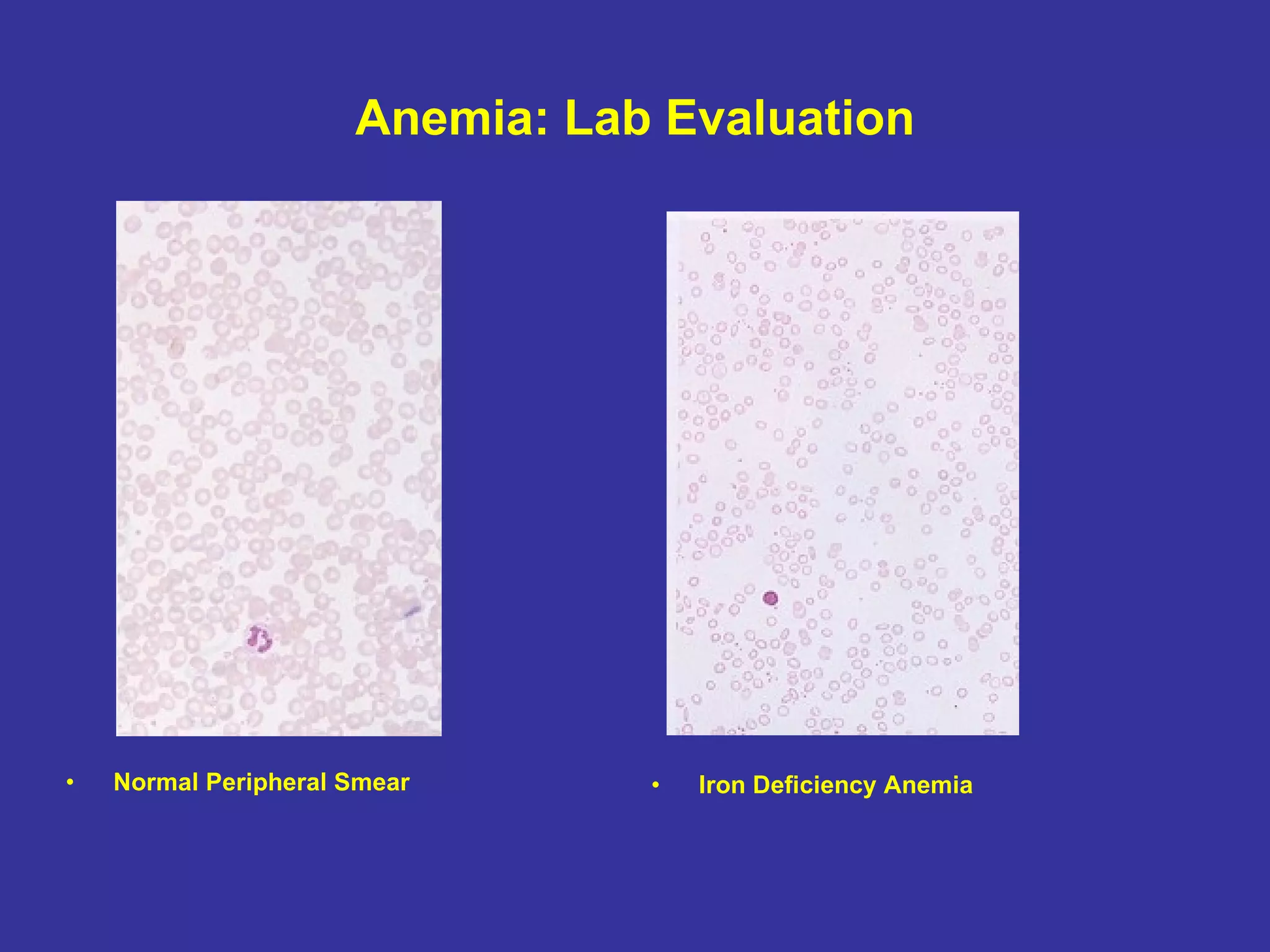 Anemia: Lab Evaluation Normal Peripheral Smear Iron Deficiency Anemia 