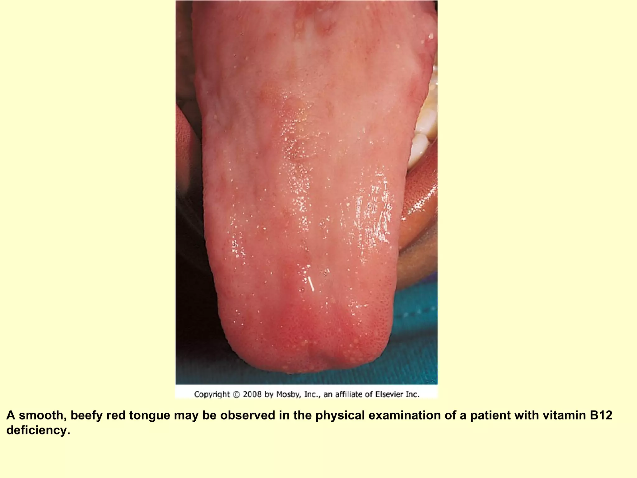 A smooth, beefy red tongue may be observed in the physical examination of a patient with vitamin B12 deficiency.  