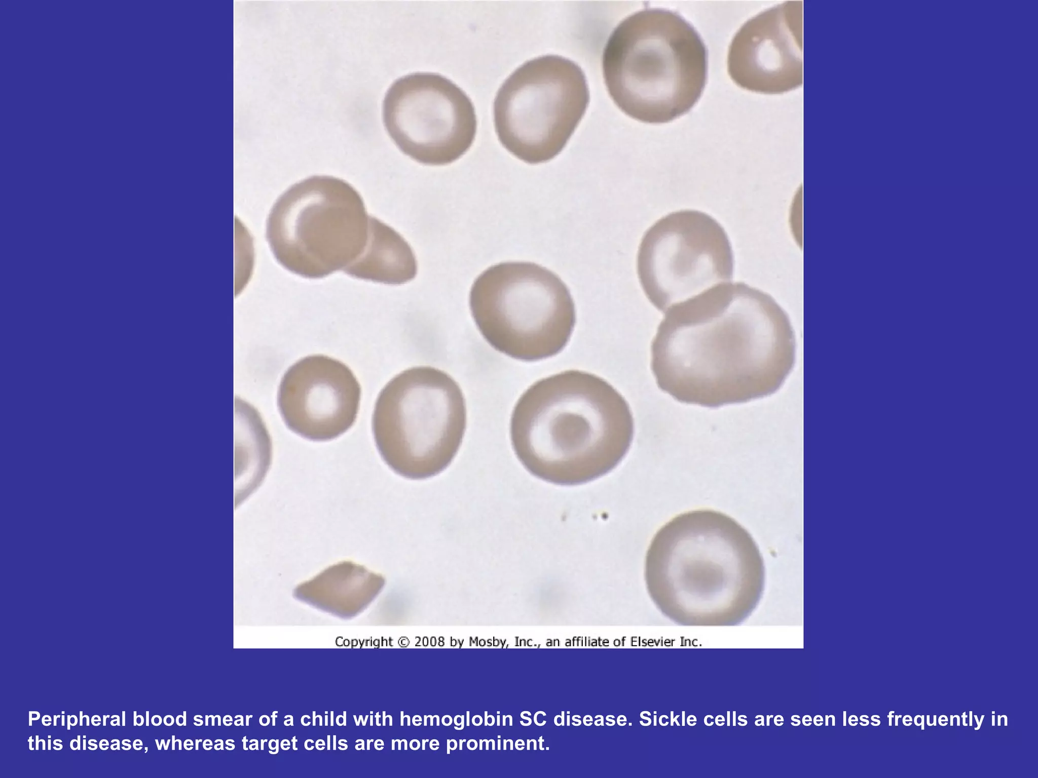 Peripheral blood smear of a child with hemoglobin SC disease. Sickle cells are seen less frequently in this disease, whereas target cells are more prominent.  