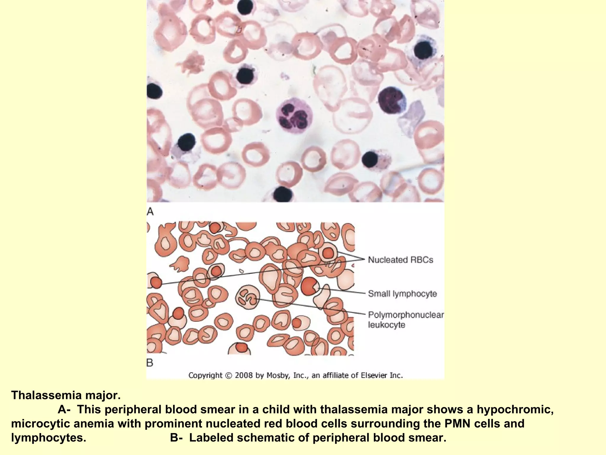 Thalassemia major.  A-  This peripheral blood smear in a child with thalassemia major shows a hypochromic, microcytic anemia with prominent nucleated red blood cells surrounding the PMN cells and lymphocytes.  B-  Labeled schematic of peripheral blood smear.  