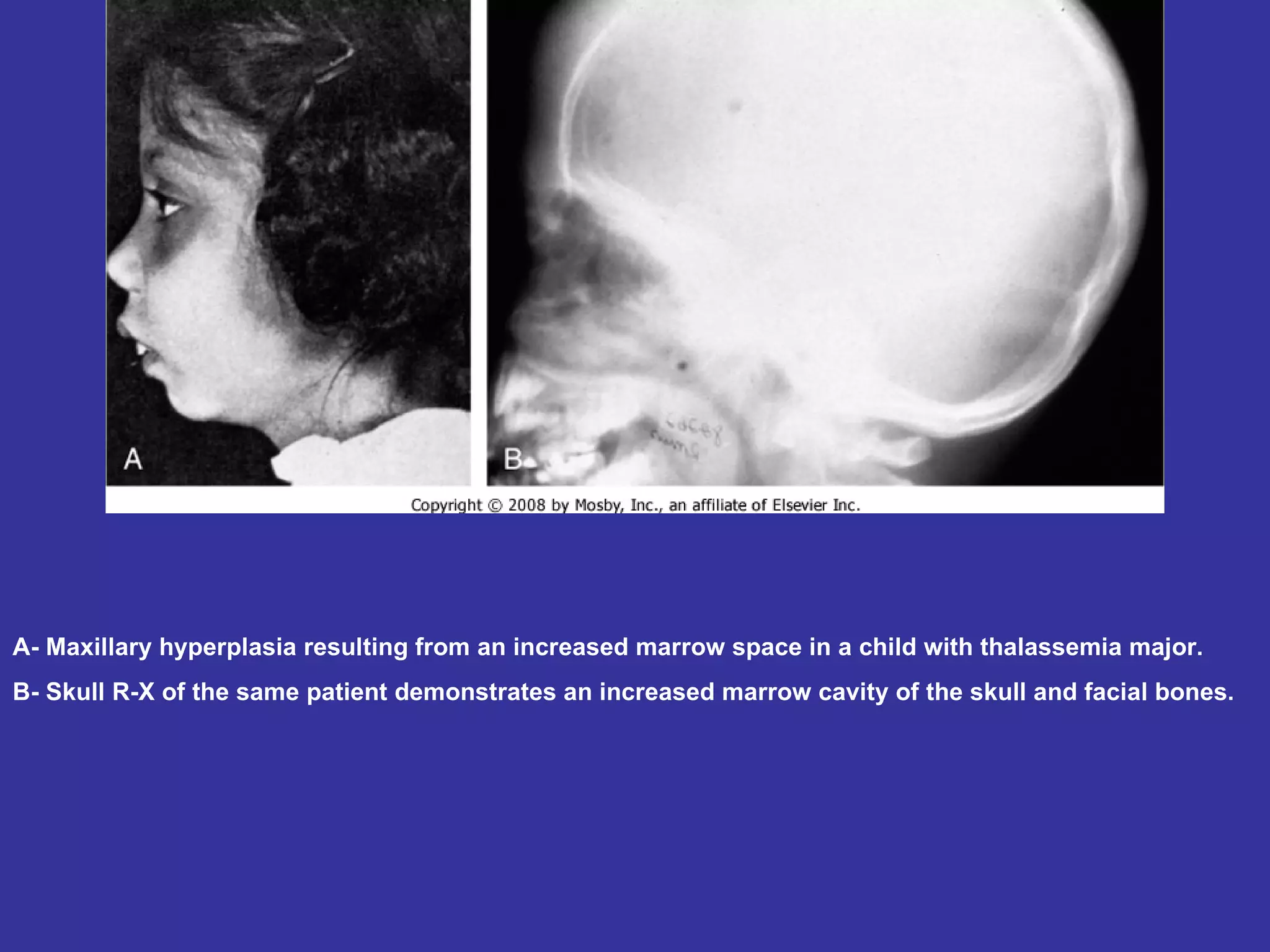 A- Maxillary hyperplasia resulting from an increased marrow space in a child with thalassemia major.  B- Skull R-X of the same patient demonstrates an increased marrow cavity of the skull and facial bones.  