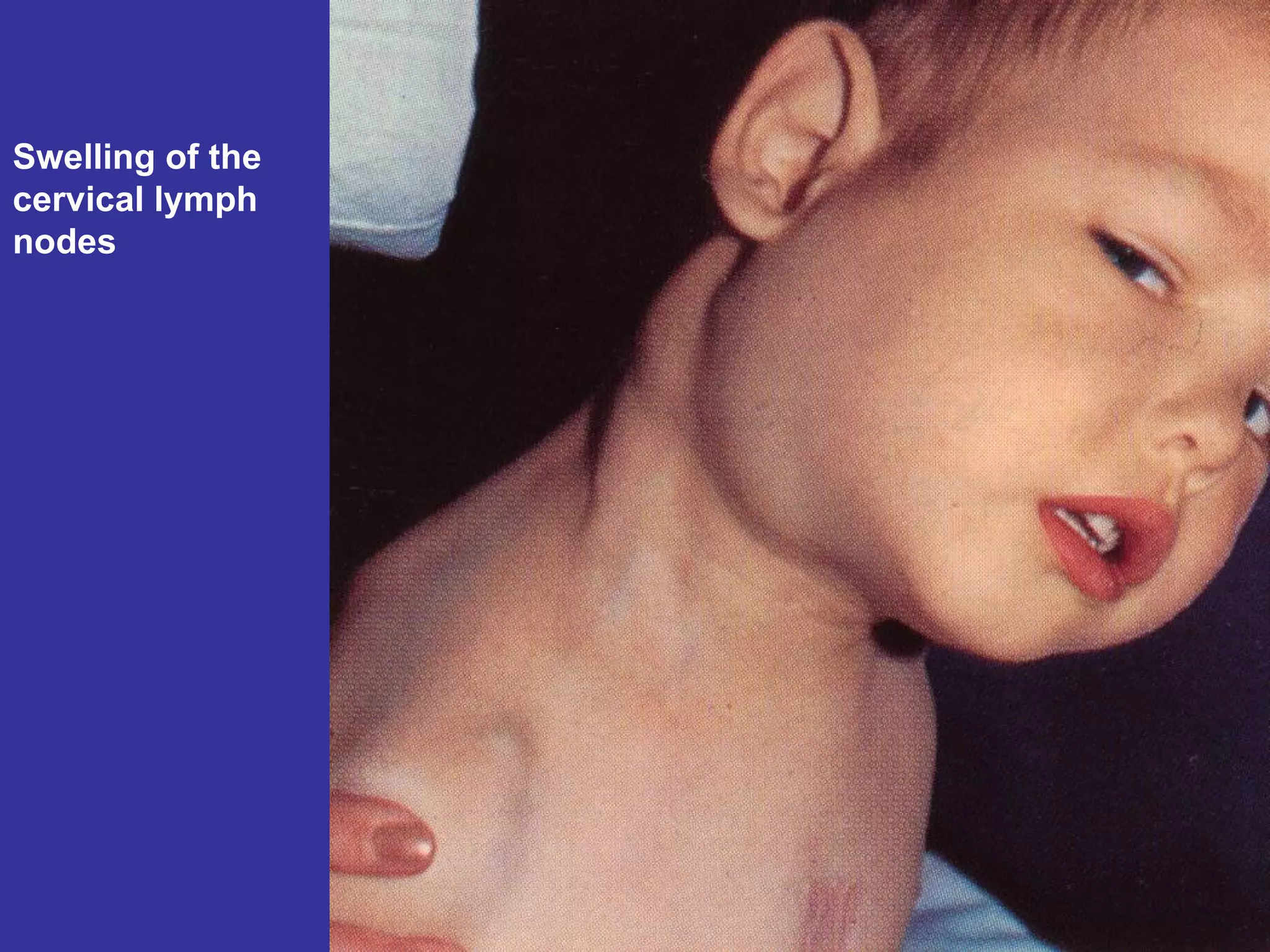 Swelling of the cervical lymph nodes 