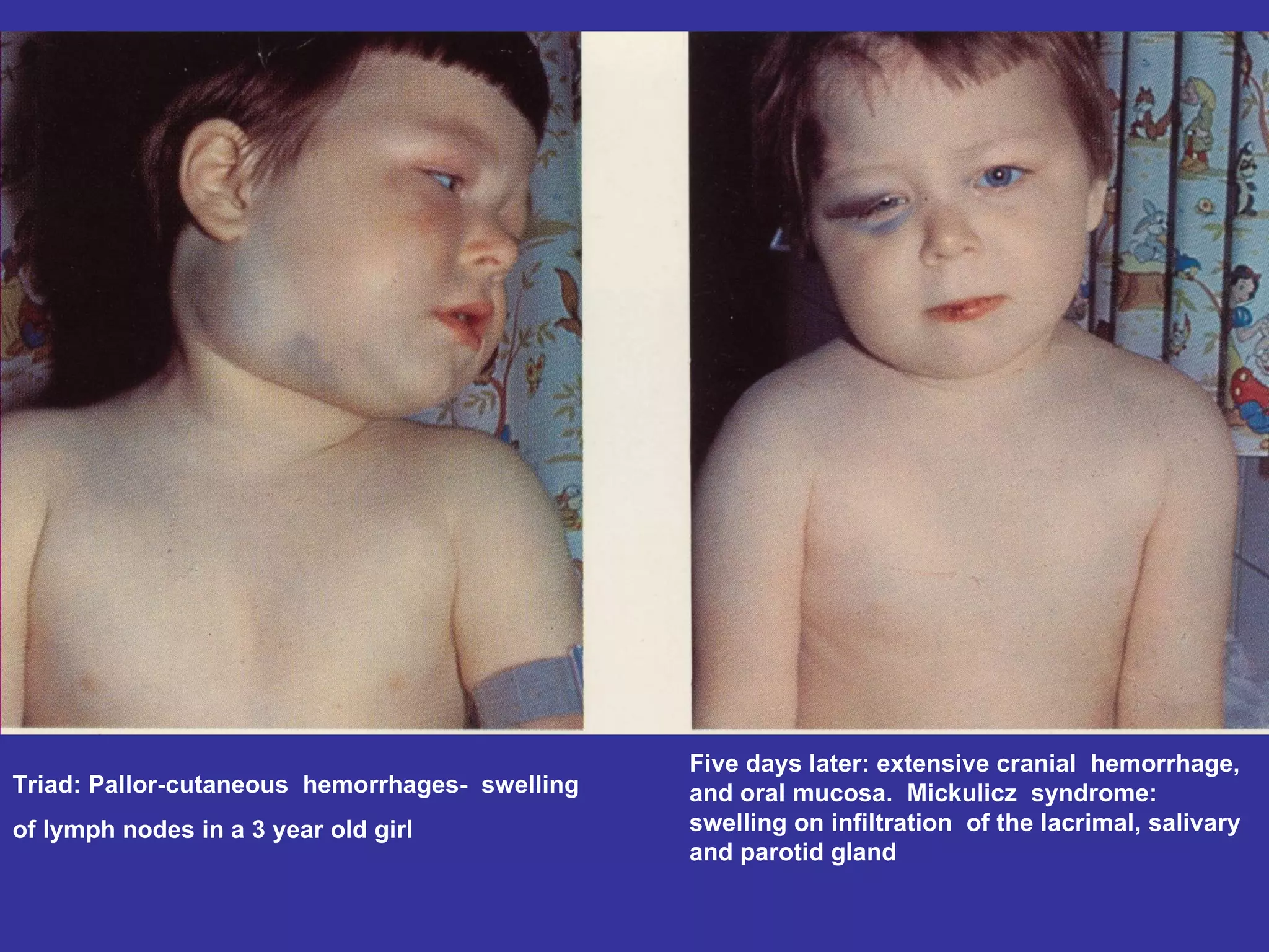 Triad: Pallor-cutaneous  hemorrhages-  swelling  of lymph nodes in a 3 year old girl  Five days later: extensive cranial  hemorrhage, and oral mucosa.  Mickulicz  syndrome: swelling on infiltration  of the lacrimal, salivary and parotid gland  