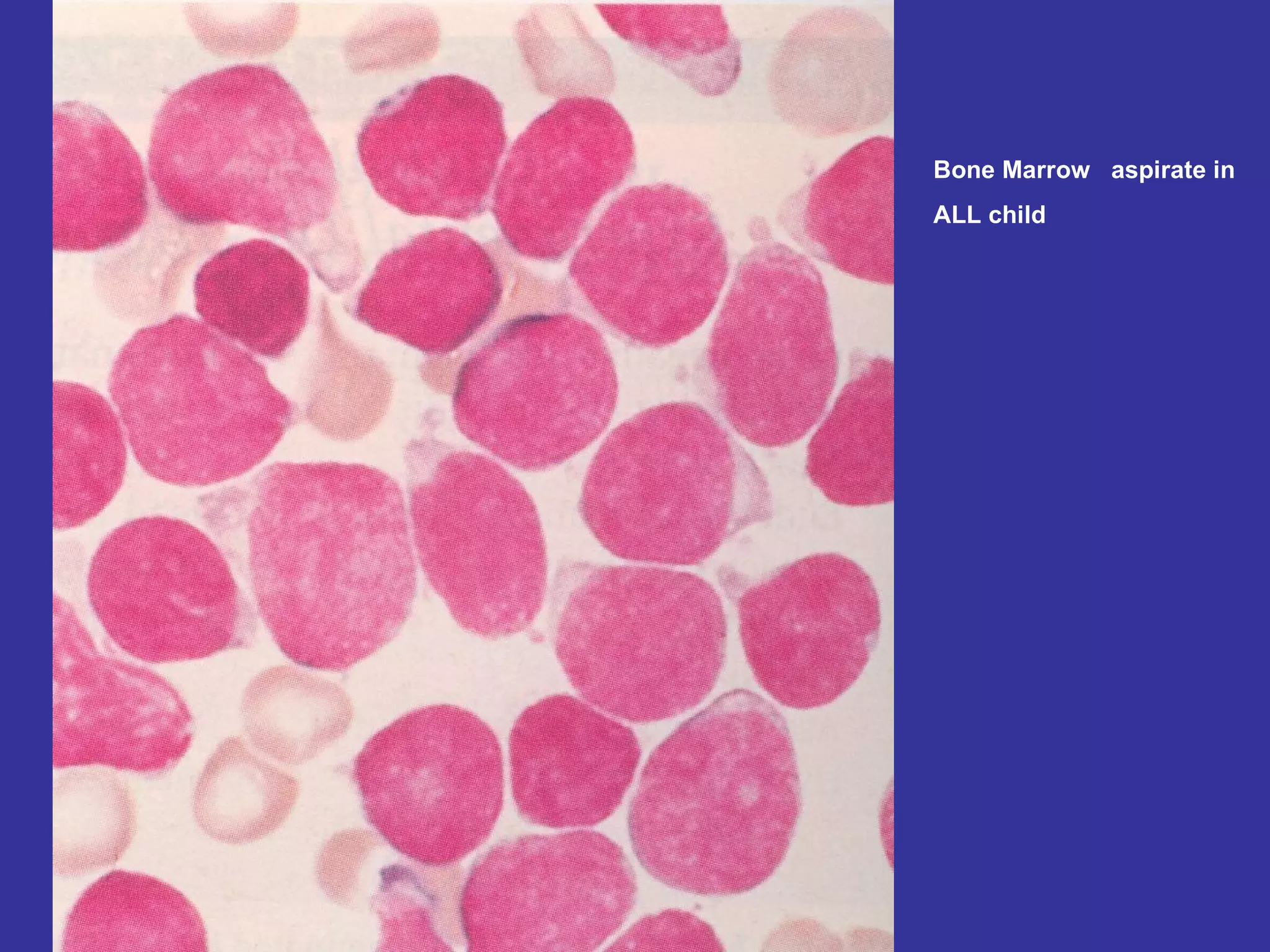 Bone Marrow  aspirate in  ALL child 