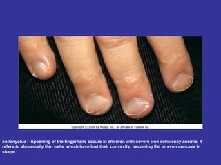 koilonychia  :   Spooning of the fingernails occurs in children with severe iron deficiency anemia. It refers to abnormally thin nails  which have lost their convexity, becoming flat or even concave in shape.  
