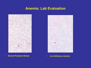Anemia: Lab Evaluation Normal Peripheral Smear Iron Deficiency Anemia 