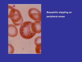 Basophilic stippling on  peripheral smear 